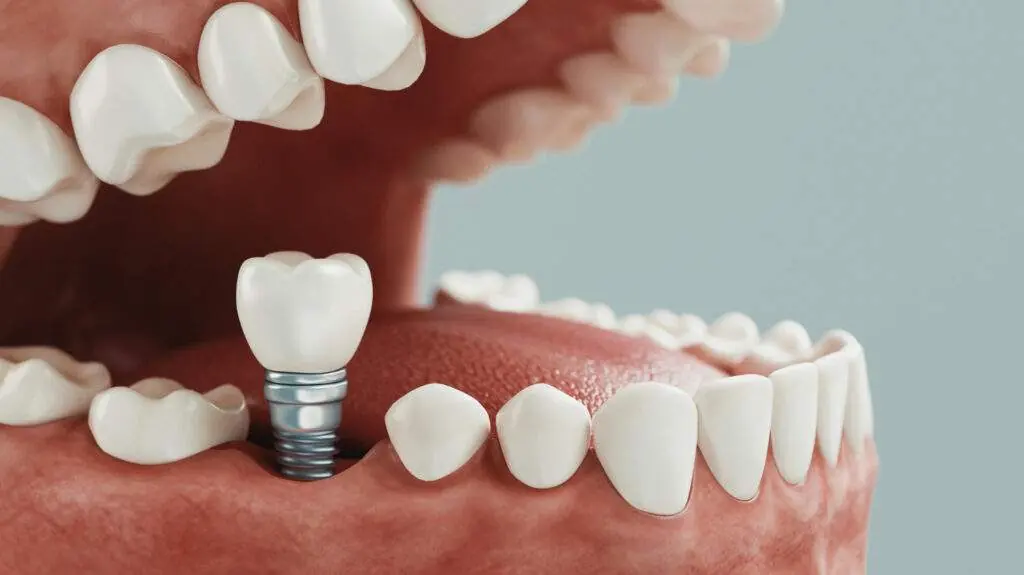 ¿Eres candidato para un implante dental? Esto es lo que debes saber