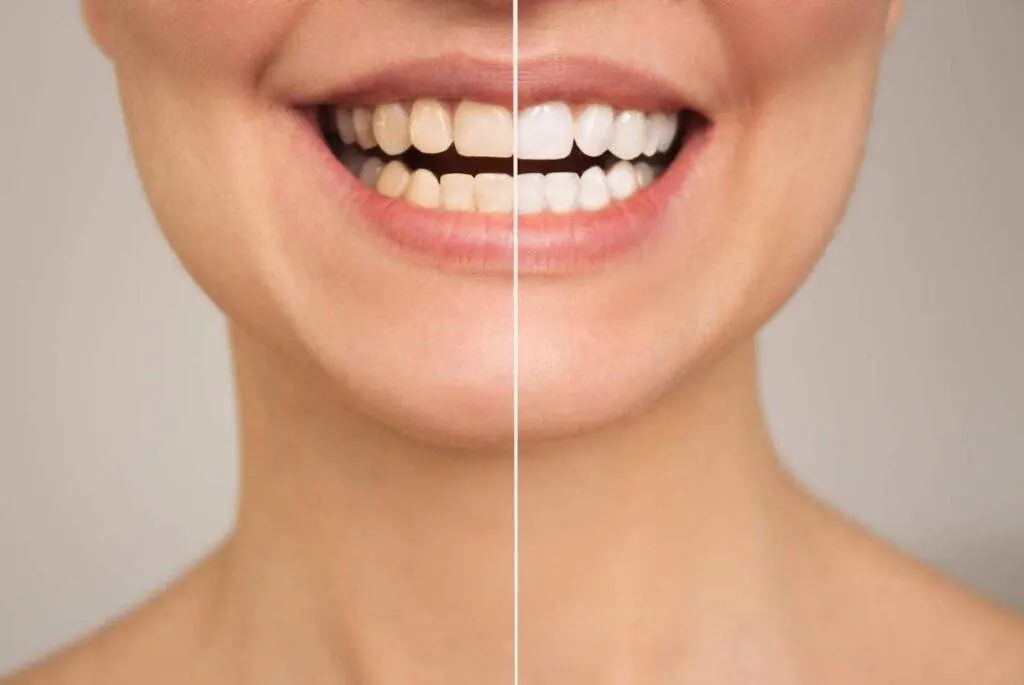 Blanqueamiento dental: cómo funciona, cuánto dura y si es para ti