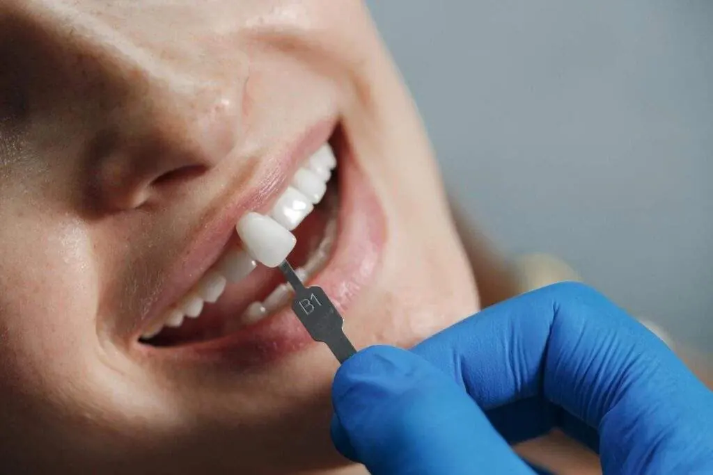 Carillas dentales: tipos, precios y resultados reales